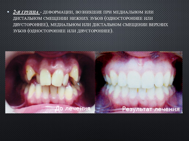 2-я группа - деформации, возникшие при ме­диальном или дистальном смещении нижних зубов (од­ностороннее или